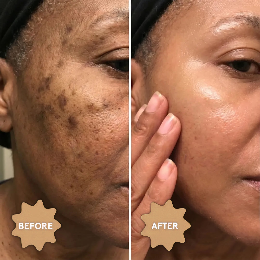 Anti-Dark Spots & Acne African Black Soap
