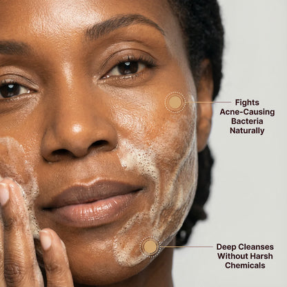 Anti-Dark Spots & Acne African Black Soap